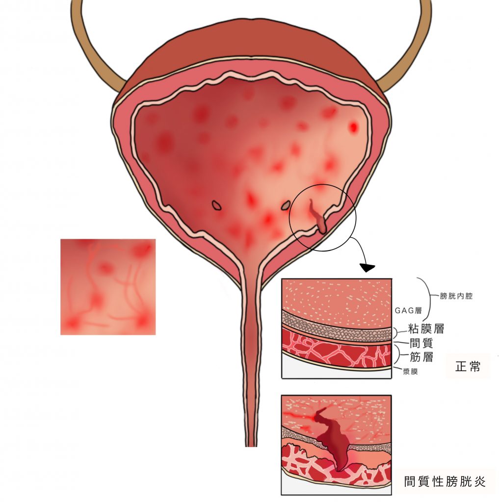 間質性膀胱炎・膀胱部痛症候群 よこすか女性泌尿器科 8153